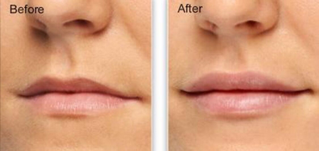 lip_enhancement_02