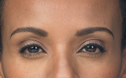 botox-02-after